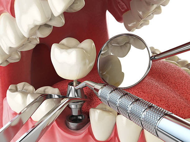 Best Emergency Wisdom Teeth Removal in Hildebran, NC